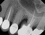The image displays a close-up view of a dental X-ray with multiple teeth and roots, showcasing various dental procedures such as braces, implants, and possibly orthodontic work.