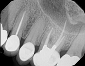 The image shows a close-up view of a dental X-ray film with several teeth, including an upper denture, displaying various levels of decay and damage.