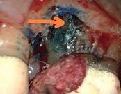 The image shows a close-up view of a tooth with severe decay and damage, surrounded by blood and tissue, indicating a dental infection or injury.