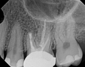 The image shows an X-ray of a human mouth with multiple teeth, including some with fillings, and a partial view of the upper jaw.