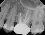 The image displays a close-up view of a dental X-ray, showing a partial view of a lower denture with teeth on one side and a visible bone structure on the other, indicating an area of dental implantation or tooth extraction.