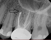 The image shows an X-ray of a human mouth with a focus on dental implants, highlighting the implant and surrounding teeth.