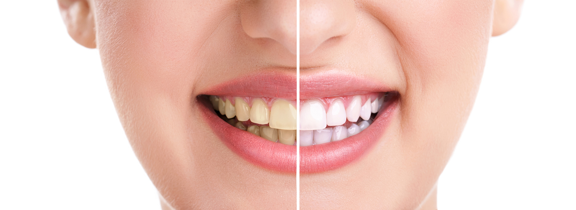 The image shows a close-up of a person s face with a smile, displaying teeth whitening before and after results, with a split view of the same individual s face on either side.