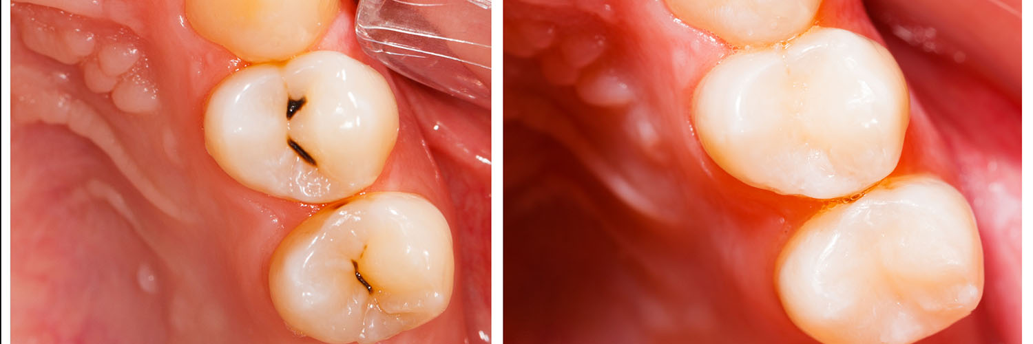 The image shows a close-up view of a dental implant with a visible screw, set against a background that appears to be a mouth with teeth.
