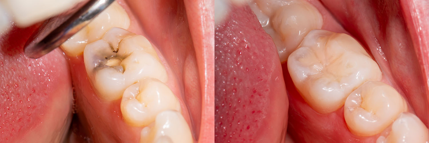The image shows a close-up view of a person s teeth with multiple cavities and gum disease, emphasizing oral hygiene issues.