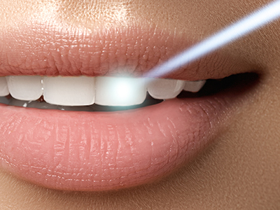 The image shows a close-up of a person s mouth with teeth, lips, and a blue light illuminating their teeth from within, likely indicating a dental care product demonstration.